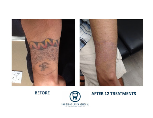 Explore animaniacs tattoo ideas, creative tattoo ideas in San Diego, available at Removery Tattoo Removal & Fading