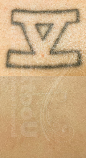 Explore skull rose tattoo ideas, creative tattoo ideas in Vienna, available at Removery Tattoo Removal & Fading