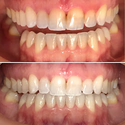 Inspiratto Odontologia: Invisalign, Implante Dentário, Harmonização Facial, Brasília DF