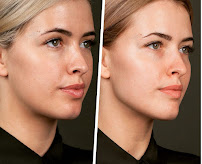 Caren Az Beauty Injector