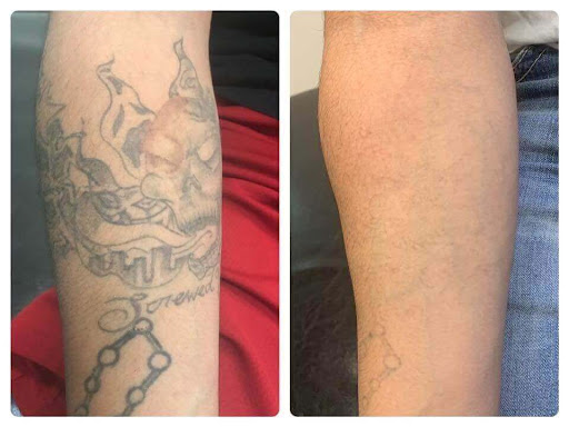 Explore birthmark tattoo ideas, creative tattoo ideas in Houston, available at Clean Canvas Laser