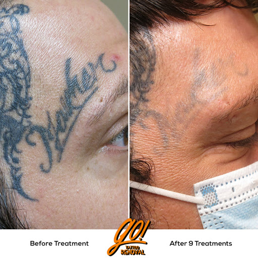 Explore kintsugi tattoo ideas, creative tattoo ideas in Allentown, available at Removery Tattoo Removal & Fading