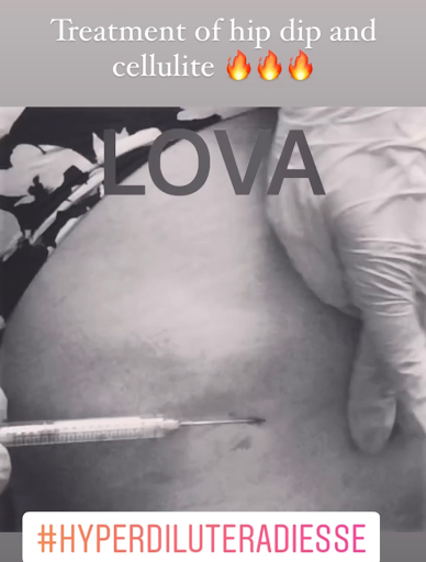 Explore tim burton tattoo ideas, creative tattoo ideas in Lake Oswego, available at Lake Oswego Vein and Aesthetic LOVA