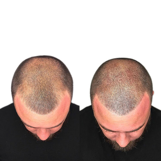 Restoration Hairline Seattle