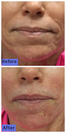 Explore bear tattoo ideas for guys, creative tattoo ideas in Lake Oswego, available at Lake Oswego Vein and Aesthetic LOVA