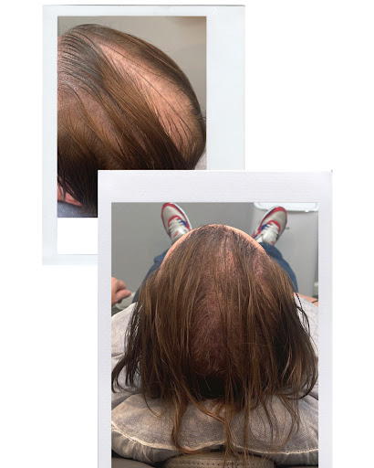 Explore sunlight tattoo ideas, creative tattoo ideas in Roseville, available at NuHair Ink. Scalp MicroPigmentation & Aesthetic Clinic of Sacramento