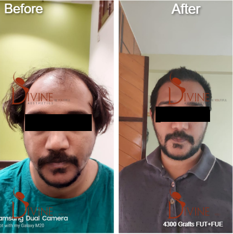 Divine™ Cosmetic Surgery - Best Hair Transplant Clinic in Delhi | Hair Transplantation Doctor In India