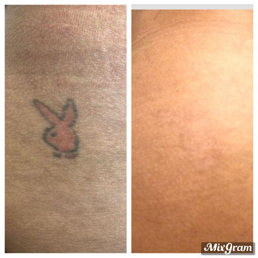 Explore ice nine kills tattoo ideas, creative tattoo ideas in Longview, available at Vanish Laser Aesthetics