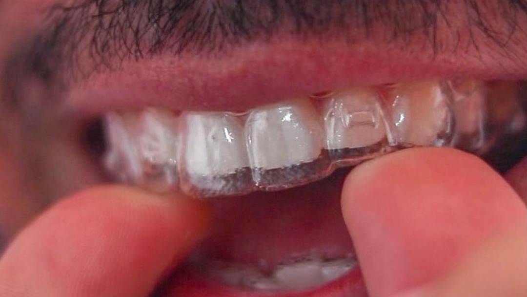 Smile Experts- Ortodoncia Invisible Invisaling