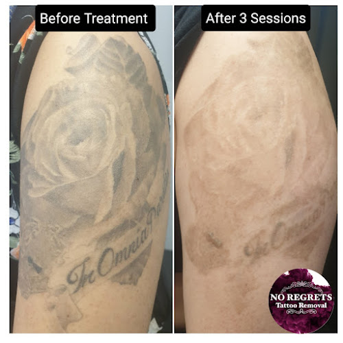 No Regrets Tattoo Removal Ltd - Tatoo shop