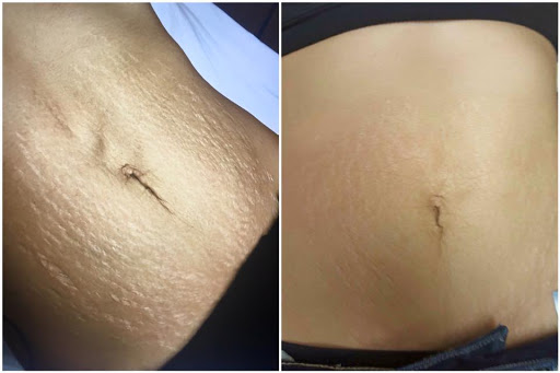 Explore meaningful self love tattoo ideas, creative tattoo ideas in Tucson, available at Allure Medical