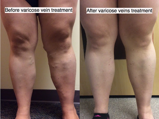 Explore venom tattoo ideas, creative tattoo ideas in Lake Oswego, available at Lake Oswego Vein and Aesthetic LOVA