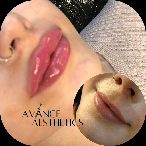 Avancé Aesthetics - Lip Fillers - Profilo - Toskani- Russian Lips - Botox Anti Wrinkle -