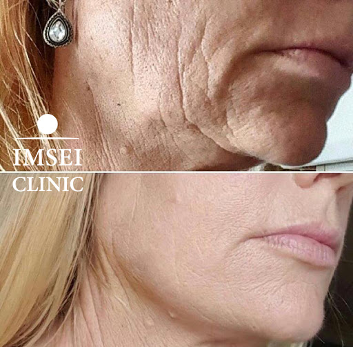 IMSEI CLINIC - Clínica Estética - Gran Canaria - Medicina Estética - Centro Médico - Tratamiento Facial y Corporal - Rejuvenecimiento y Rellenos Faciales y Corporales - Mesoterapia Botox Ácido Hialurónico,Medicina Regenerativa y células madre