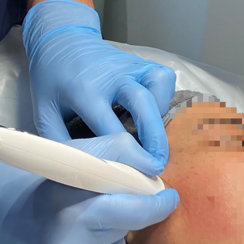 Harrow Microneedling Clinic - Affordable Microneedling Specialist