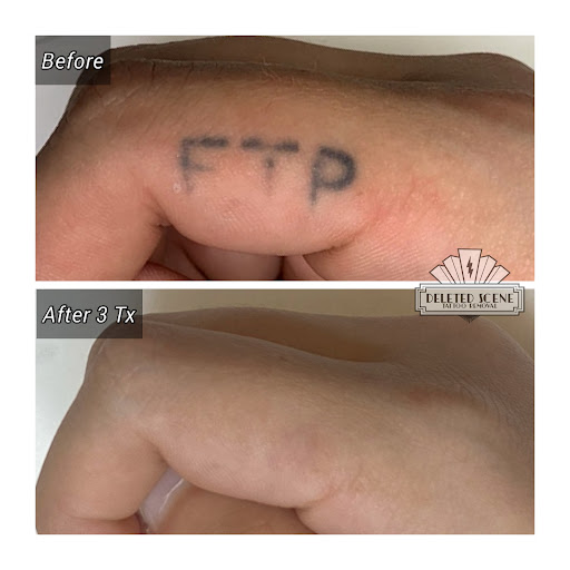 Explore skydive tattoo ideas, creative tattoo ideas in Hatboro, available at Deleted Scene Tattoo Removal