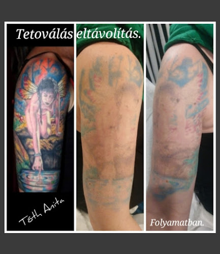 Lézeres Tetoválás eltávolítás Picosure és kozmetika Tóth Anita - Tetoválószalon