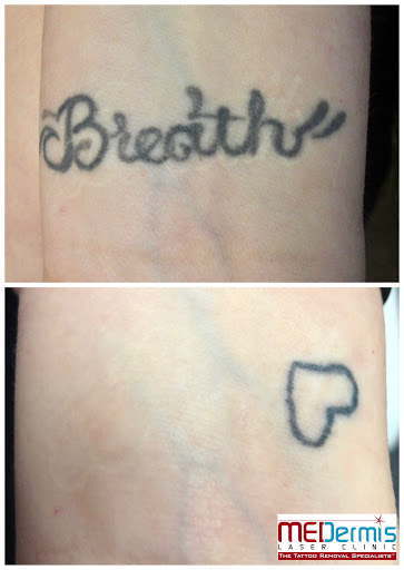 Explore simple easy tattoo ideas, creative tattoo ideas in San Antonio, available at MEDermis Tattoo Removal