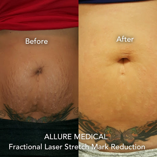 Explore line tattoo ideas for guys, creative tattoo ideas in Tucson, available at Allure Medical