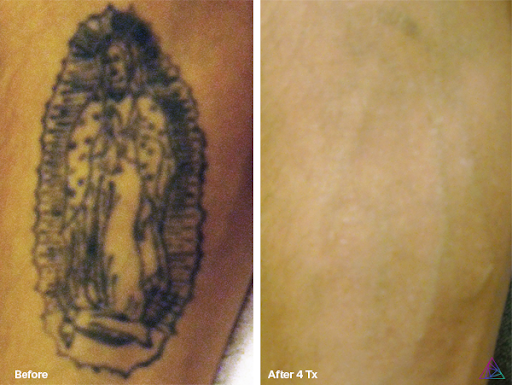 Explore tattoos ideas for depression, creative tattoo ideas in Rowlett, available at Bonsai Laser Tattoo Removal