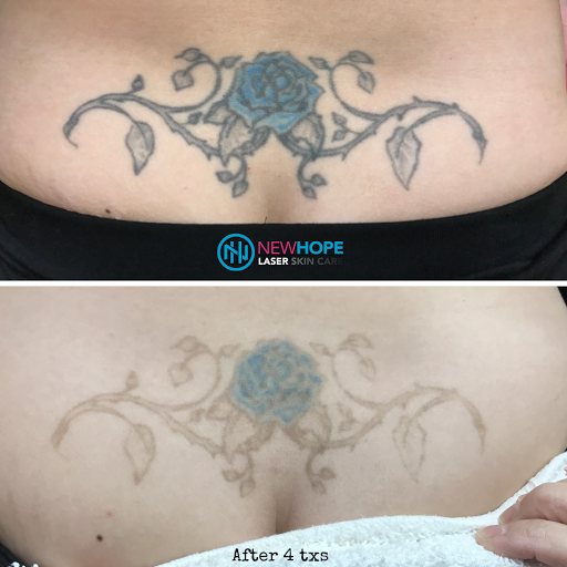 Explore lil uzi vert tattoos ideas, creative tattoo ideas in Westminster, available at Newhope Laser Skin Care