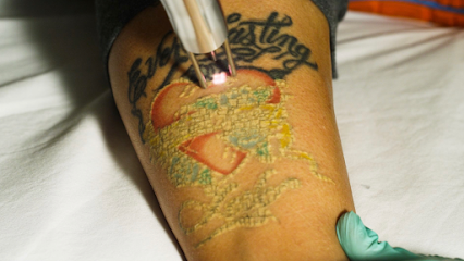 Regretful Heart Laser Tattoo Removal