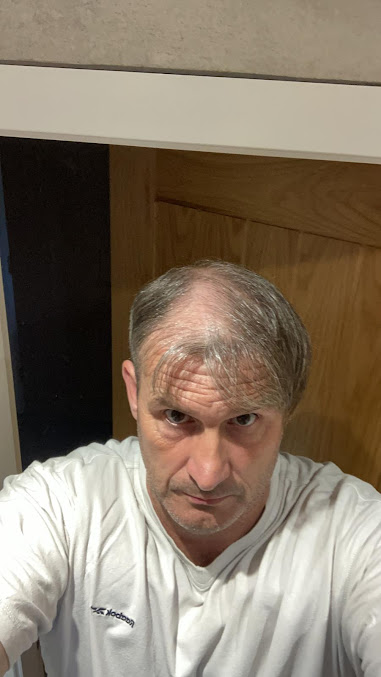 Better Hair Transplant Clinics - Nottingham - Better Hair Transplant Clinics - Nottingham