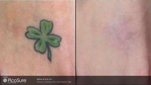 Explore arm tattoo placement ideas, creative tattoo ideas in Pleasant Grove, available at Inklifters Tattoo Removal