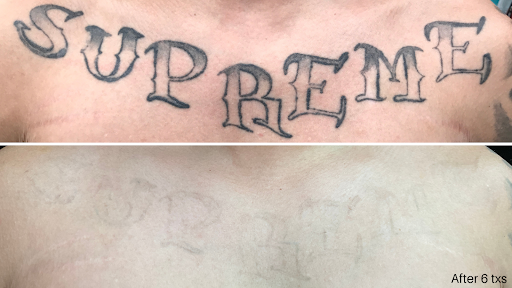 Explore tattoo ideas aries, creative tattoo ideas in Westminster, available at Newhope Laser Skin Care