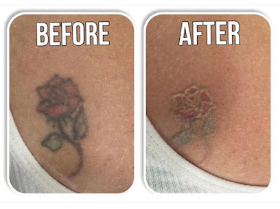 UNDO Tattoo - laser tattoo removal