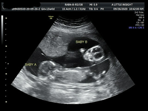 A Little Insight 3D 4D 5D Ultrasound image