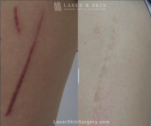 Explore sonic tattoo ideas, creative tattoo ideas in Southampton, available at Laser & Skin Surgery Center of New York - Southampton