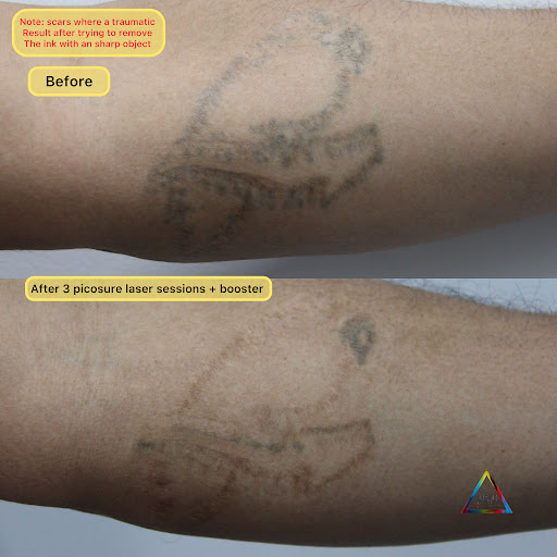 Explore cover up tattoos ideas, creative tattoo ideas in New York, available at Ag2g Laser Tattoo Removal & MedSpa