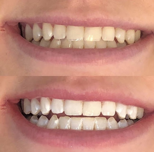 Puresmile Teeth Whitening Adelaide