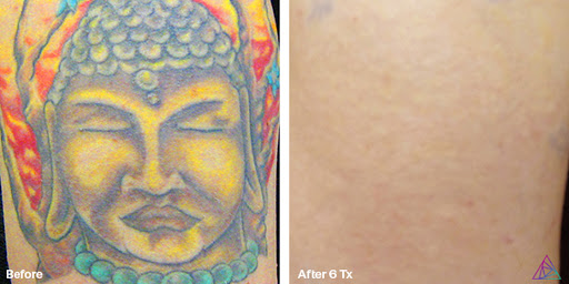 Explore teen wolf tattoo ideas, creative tattoo ideas in Fort Myers, available at Laser Tattoo Removal by Tatt Cemetery