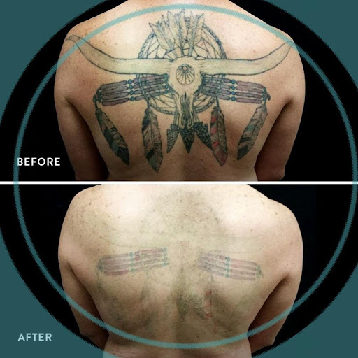 Explore indian chief tattoo ideas, creative tattoo ideas in Glen Mills, available at Removery Tattoo Removal & Fading