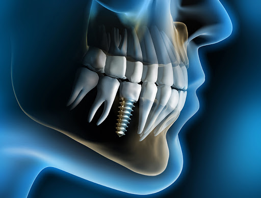 ĐỊA CHỈ CẮM IMPLANT HÀ NỘI