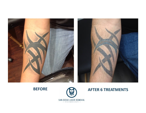 Explore tattoo ideas for perseverance, creative tattoo ideas in San Diego, available at Removery Tattoo Removal & Fading