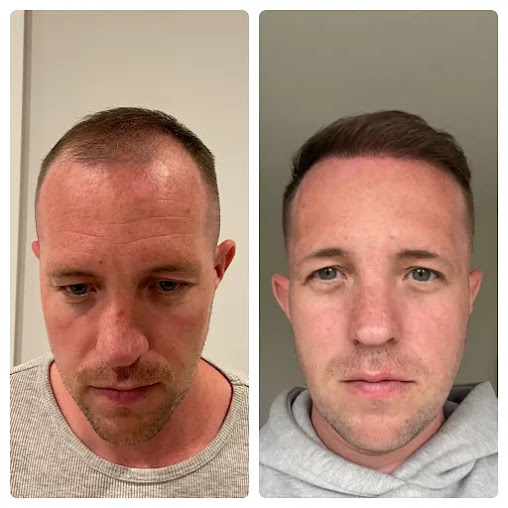 Better Hair Transplant Clinics - Nottingham - Better Hair Transplant Clinics - Nottingham