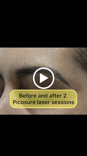 Explore pug tattoo ideas, creative tattoo ideas in New York, available at Ag2g Laser Tattoo Removal & MedSpa