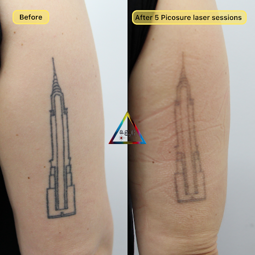 Explore tramp stamp lower back tattoo cover up ideas, creative tattoo ideas in New York, available at Ag2g Laser Tattoo Removal & MedSpa