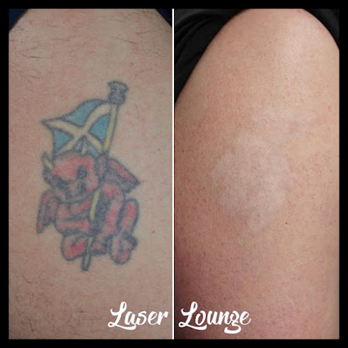 Laserlounge-Tattoo fjernelse - Butik