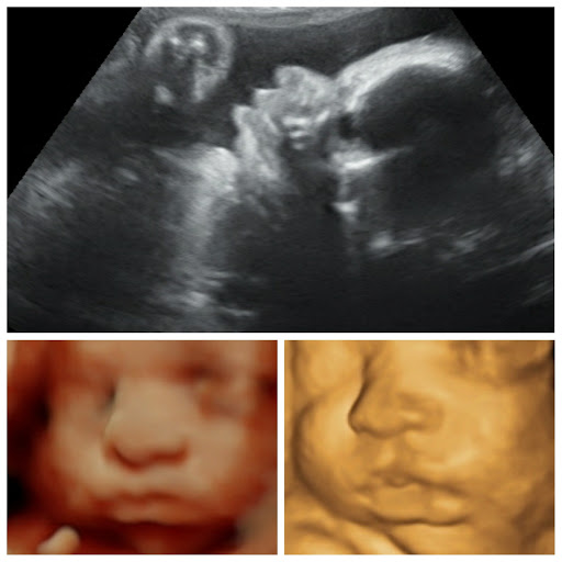A Little Insight 3D 4D 5D Ultrasound image