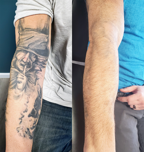 Explore cover up tattoo ideas for guys, creative tattoo ideas in Rochester, available at Rochester Tattoo Removal