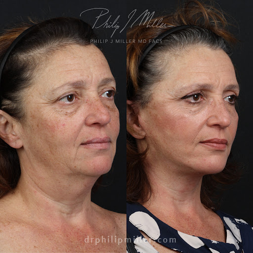 Dr. Philip Miller - #1 Facelift and Rhinoplasty Surgeon in New York