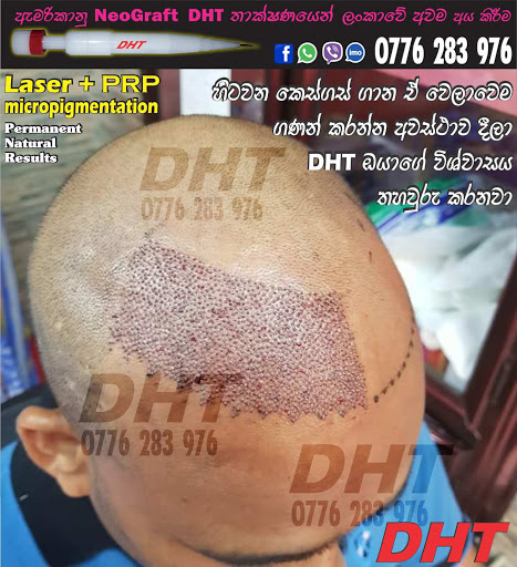 DHT Hair Transplant SriLanka - Hospital in Nugegoda