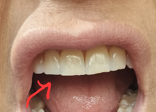 Teeth whitening Dubai