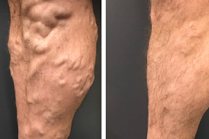 Melbourne Varicose Vein image