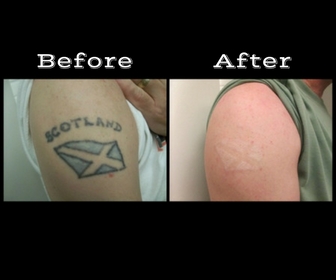 Explore brother tattoo ideas, creative tattoo ideas in Longview, available at Vanish Laser Aesthetics