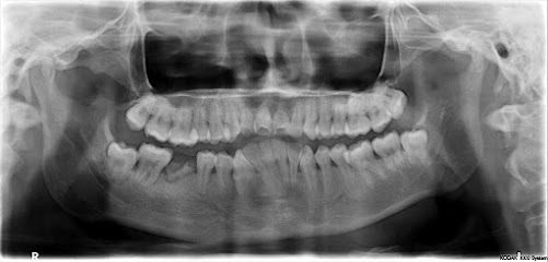 Radiografia Panoramica | Radiografia Dental